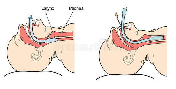 气管子图片