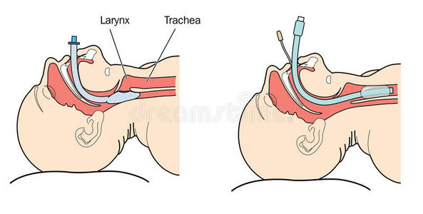 气管插管步骤图片图片