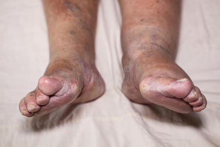 老年人腿部问题照片