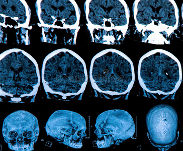 核磁共振脑扫描照片