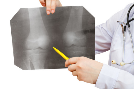 护士点与人体膝关节的 x 射线图片