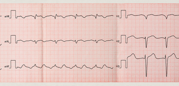 磁带心电图与阵发性心房扑动