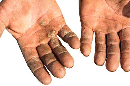 受伤的手掌开照片