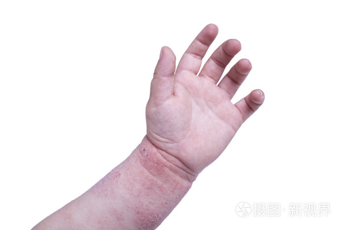 孩子们的手上湿疹