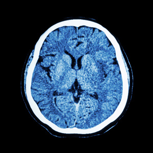 脑CT扫描显示正常人脑CAT扫描