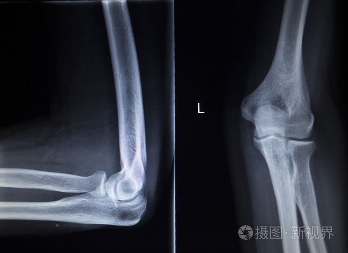 x 射线骨科骨伤科扫描的肘部关节损伤