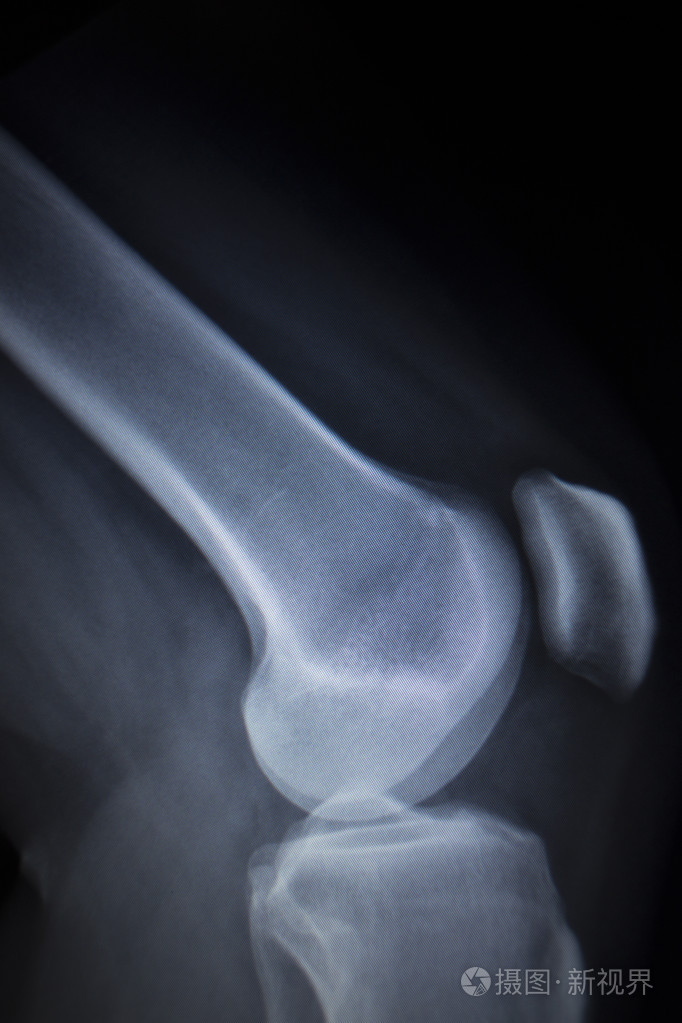 膝前痛腿半月板损伤的 x 线骨科扫描