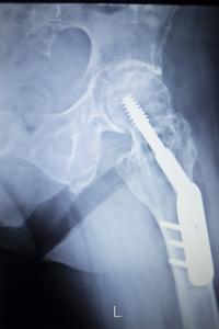 髋关节置换骨科植入物的 x 射线扫描图像