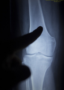 膝前痛腿半月板损伤的 x 线骨科扫描
