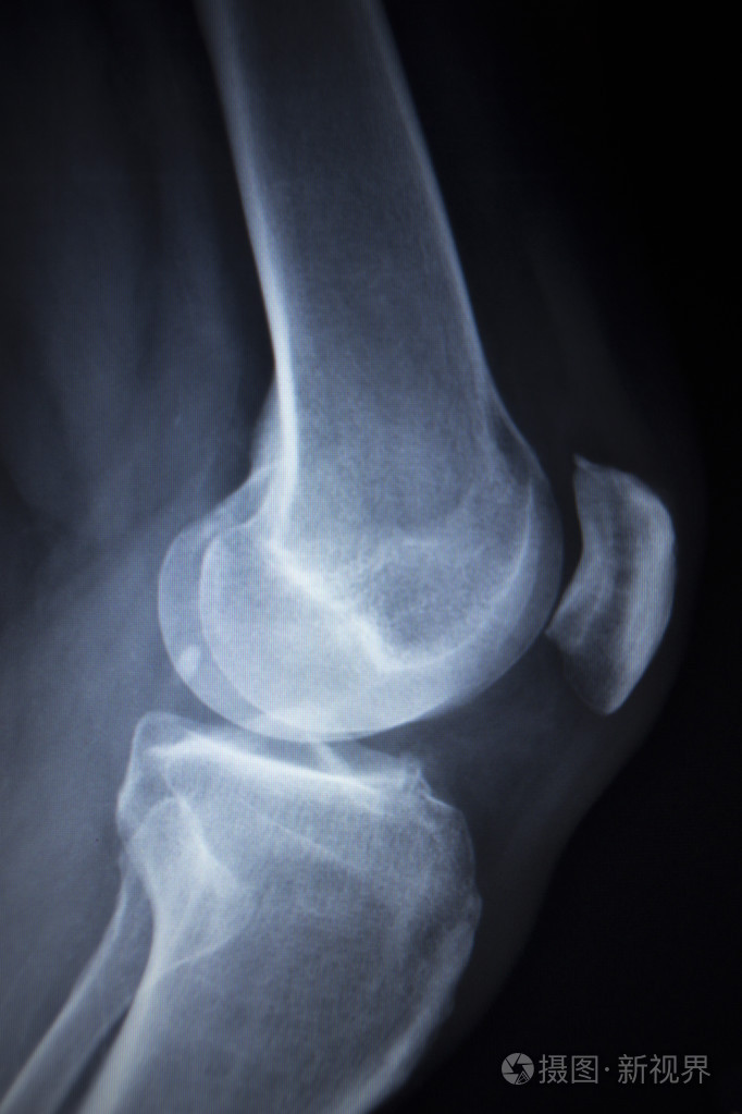 膝前痛腿半月板损伤的x线骨科扫描