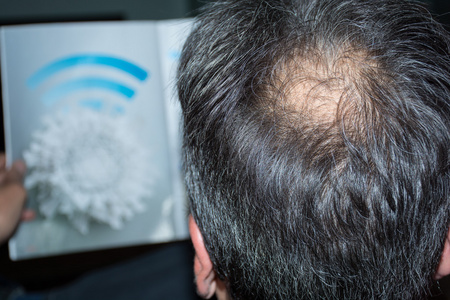 掉头发成熟的男人,与秃头照片