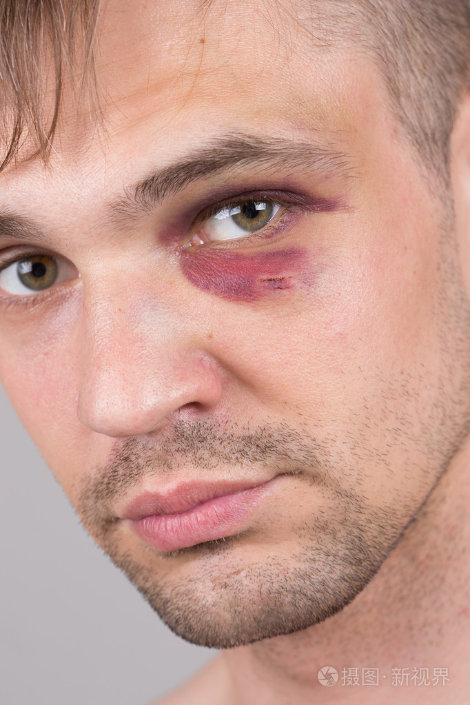 受伤的眼睛的人特写