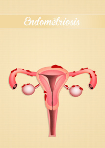 子宫内膜异位症图片