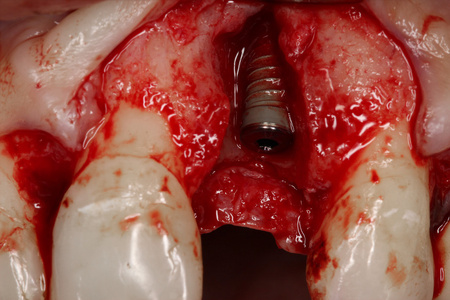 牙齿手术照片图片
