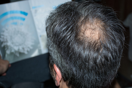 胡须斑白的祖父.脱发.早期迹象秃顶.掉头发的男人.人造头发.