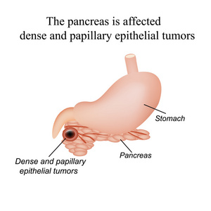 胰腺是受影响的密集和乳头状上皮性肿瘤。对孤立背景矢量图