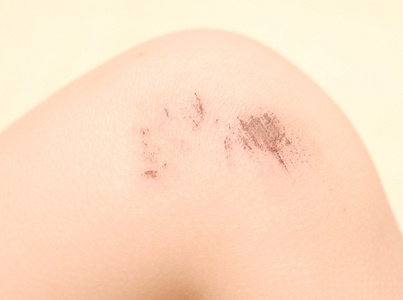 一个小孩的膝盖被刮伤照片