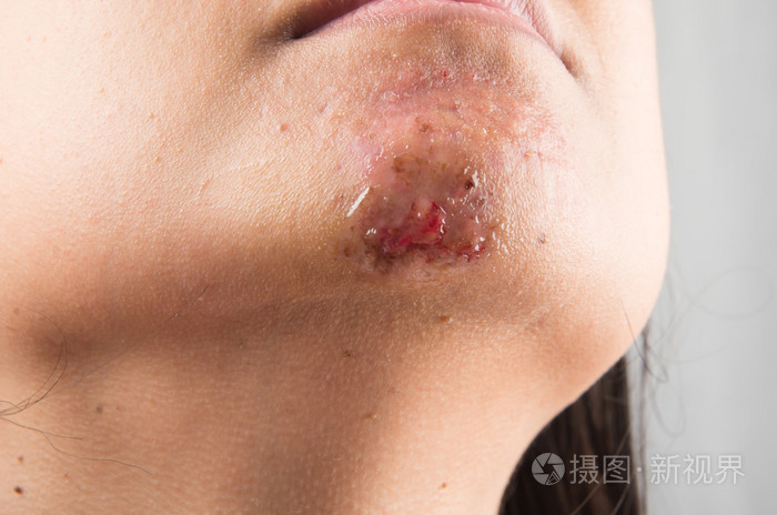 缝合后意外对妇女下巴的损伤