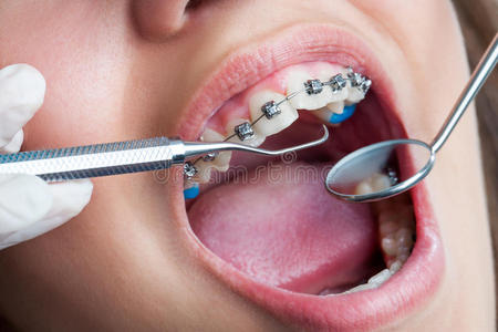 用牙套对人的嘴进行极端特写。