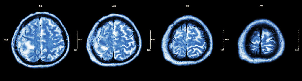 脑肿瘤脑膜ct扫描显示部分脑T