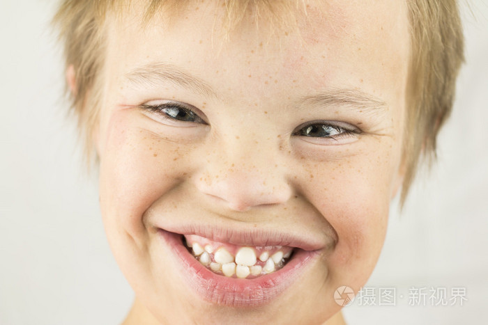 唐氏综合症的脸