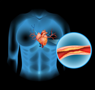 心脏疾病引起的 cholesteral