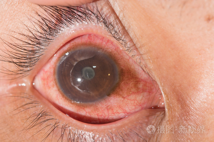 眼科检查虹膜后粘连