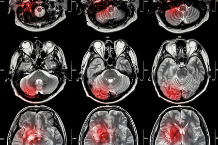 电影 Mri 磁共振成像 的大脑 中风 脑肿瘤 脑梗塞 脑出血 医疗 卫生保健 科学背景 脑的横断面 