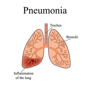 肺炎。人肺的解剖结构。对孤立背景矢量图