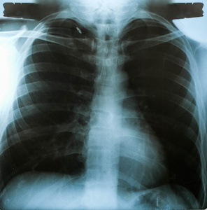 X 射线图像，对医学诊断的胸部男人的看法