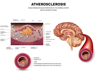 动脉粥样硬化。稳定斑块形成