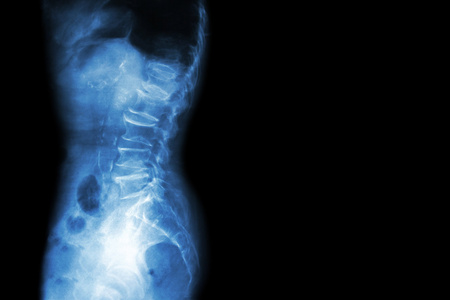 颈椎病 腰椎滑脱症 薄膜 x 射线腰骶脊柱显示脊柱崩溃，减少在光盘空间，骨刺形成形成 侧，横向视图 和空白区域在右侧