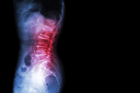 颈椎病 腰椎滑脱症 薄膜 x 射线腰骶脊柱显示脊柱崩溃，减少在光盘空间，骨刺形成形成 侧，横向视图 和空白区域在右侧