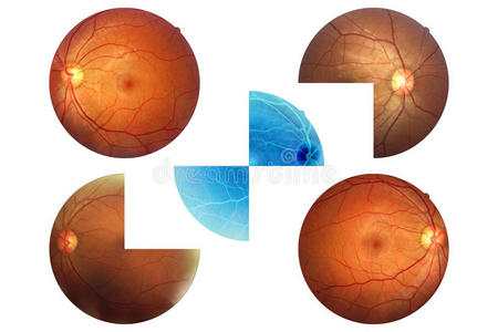 人眼解剖视网膜视盘动静脉等。