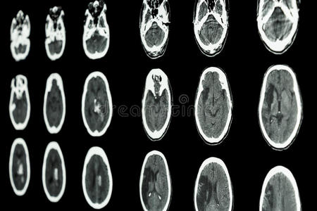 脑片ct扫描显示缺血性脑卒中和出血性脑卒中