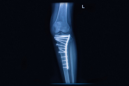 x 射线的骨折 tibialeg bone。胫骨骨与内部定势