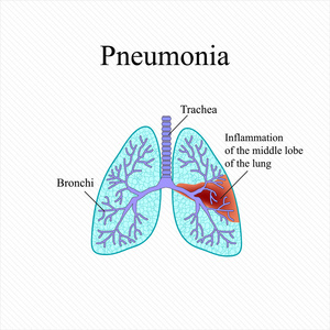 肺炎。人肺的解剖结构。肺中叶的炎症。矢量图