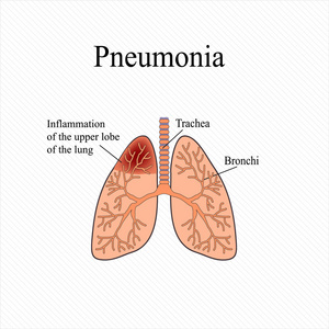 肺炎。人肺的解剖结构。上部叶的肺的炎症。矢量图