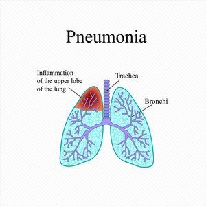 肺炎。人肺的解剖结构。上部叶的肺的炎症。矢量图