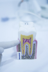 牙科牙齿铸造模型显示朽烂牙釉质根