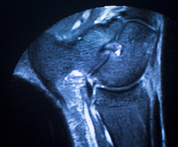 mri 磁共振成像踝关节扫描