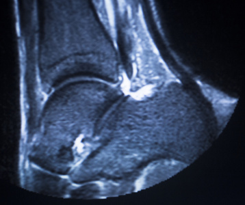 mri 磁共振成像踝关节扫描