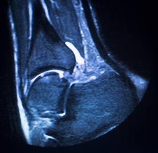 mri 磁共振成像踝关节扫描