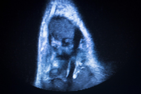 mri 磁共振成像踝关节扫描