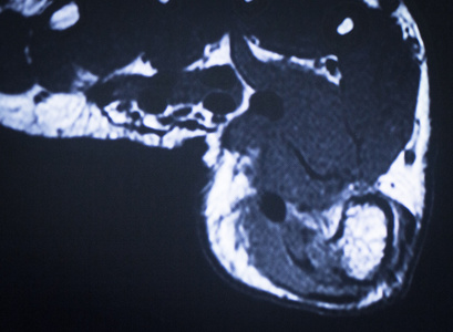 mri 磁共振成像足部脚趾扫描