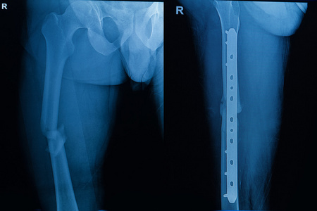人类x射线采集显示股骨骨折
