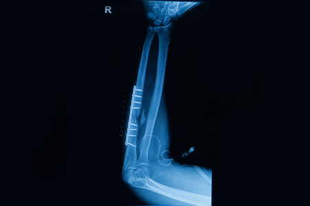 人类的集合 x 光片显示骨折的桡骨骨