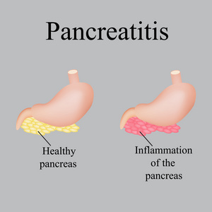 胰腺的炎症。胰腺炎。在灰色的背景上的矢量图