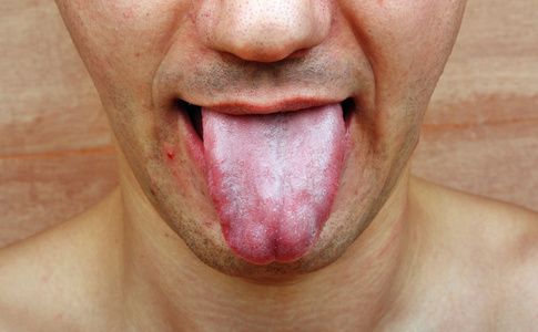 疾病舌头感染