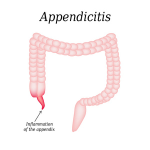 阑尾炎。阑尾发炎。结肠。对孤立的背景图